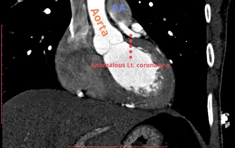 File:Anomalous left coronary artery from the pulmonary artery (ALCAPA) (Radiopaedia 70148-80320 Coronal 1).jpg