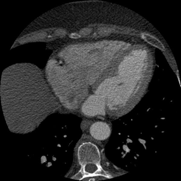 File:Anomalous origin of left circumflex artery from right coronary sinus (Radiopaedia 72563-83117 B 123).jpg