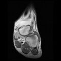 Anterior calcaneal process fracture (Radiopaedia 74654-85611 Coronal T1 4).jpg