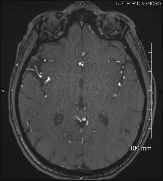 File:Anterior cerebral artery aneurysm (Radiopaedia 80683-94127 Axial MRA 125).jpg