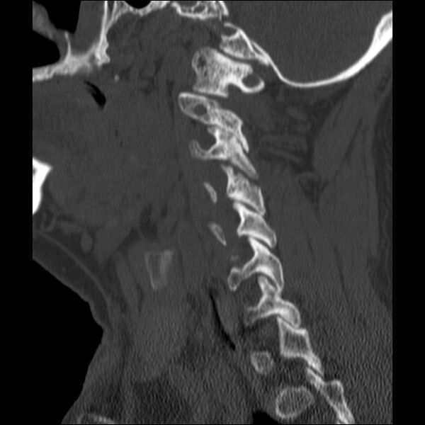File:Anterior cervical postdiscectomy arthrodesis (Radiopaedia 32678-33646 Sagittal bone window 56).jpg