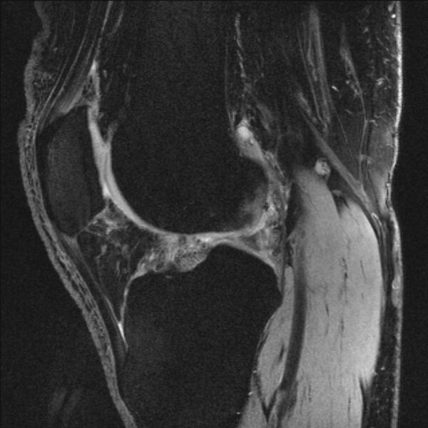 File:Anterior cruciate ligament mucoid degeneration (Radiopaedia 68400-77933 Sagittal 26).jpg