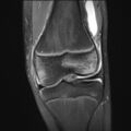 Anterior cruciate ligament tear - pediatric (Radiopaedia 62152-70260 Coronal PD fat sat 15).jpg