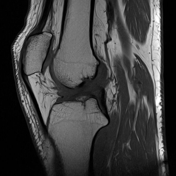 File:Anterior cruciate ligament tear - ramp lesion (Radiopaedia 71883-82322 Sagittal T1 13).jpg
