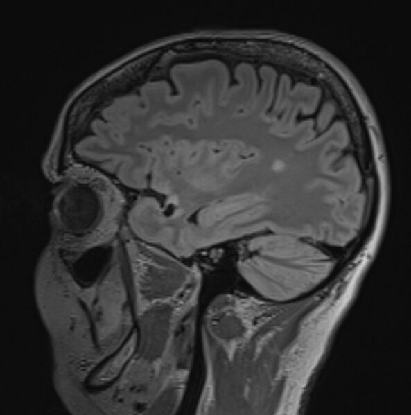 File:Anterior temporal lobe perivascular space (Radiopaedia 40946-43650 Sagittal FLAIR 1).JPG