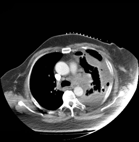 File:Aortic arch false aneurysm (Radiopaedia 14667-14588 A 10).jpg