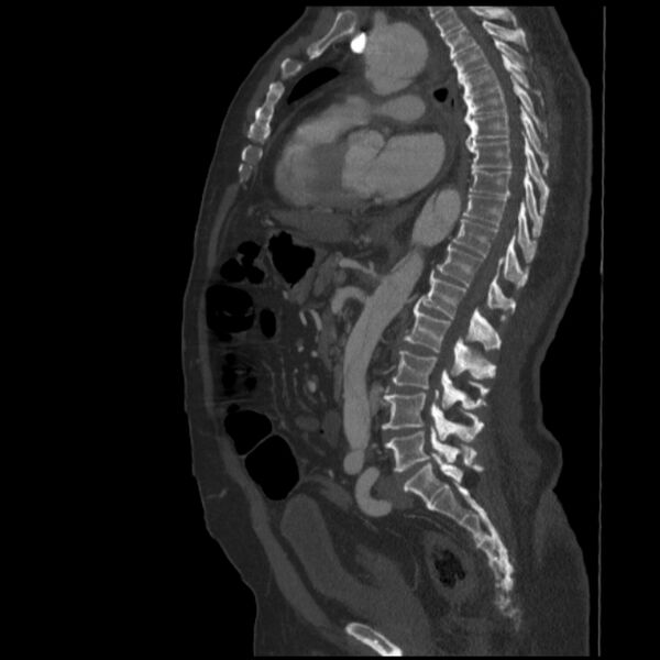 File:Aortic dissection (Radiopaedia 28802-29105 C 20).jpg