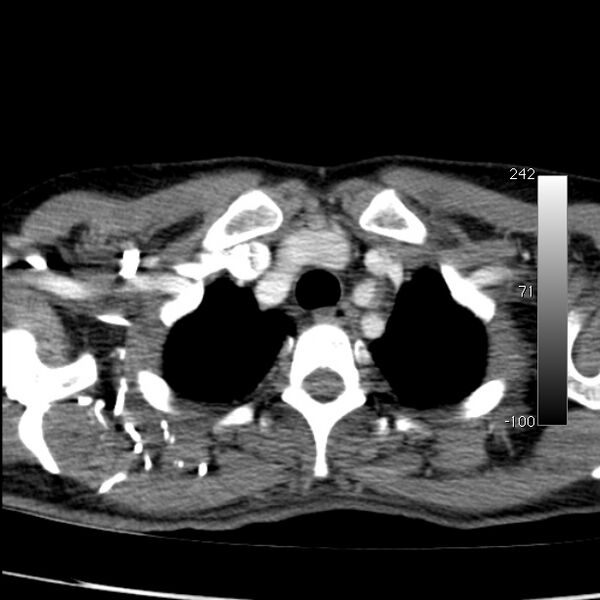 File:Aortic dissection - Stanford type A (Radiopaedia 29247-29659 A 12).jpg
