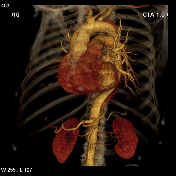 File:Aortic dissection with rupture into pericardium (Radiopaedia 12384-12647 C+ arterial phase 35).jpg