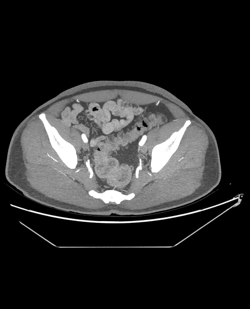 Aplastic posterior tibial arteries (Radiopaedia 84021-99249 A 89).jpg