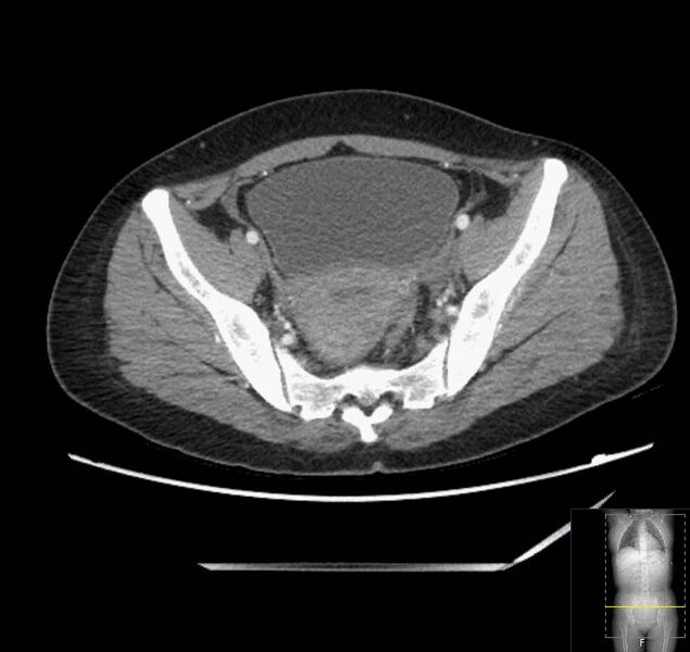 File:Appendicitis (CT angiogram) (Radiopaedia 154713-127660 Axial 20).jpg