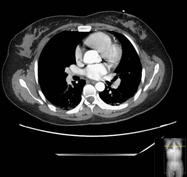 File:Appendicitis (CT angiogram) (Radiopaedia 154713-127660 Axial 200).jpg