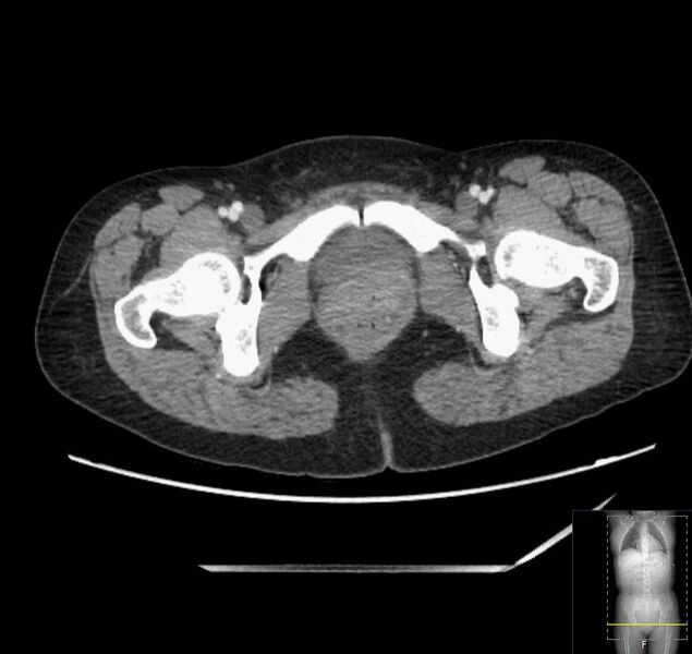 File:Appendicitis (CT angiogram) (Radiopaedia 154713-127660 Axial 82).jpg