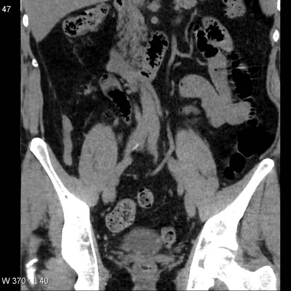 File:Appendicitis (Radiopaedia 12510-12733 Coronal non-contrast 16).jpg