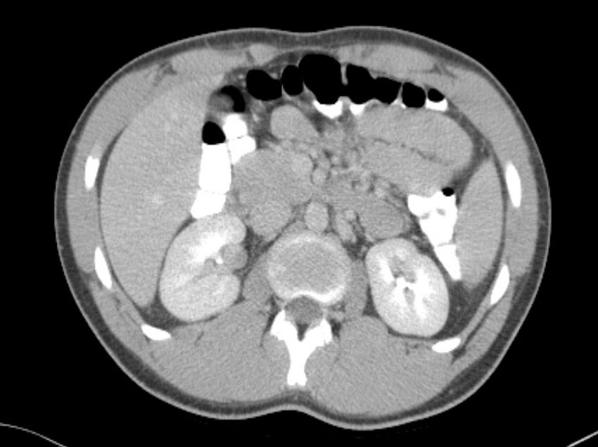 Appendicitis and incidental foregut duplication cyst (Radiopaedia 52962-58916 A 16).jpg