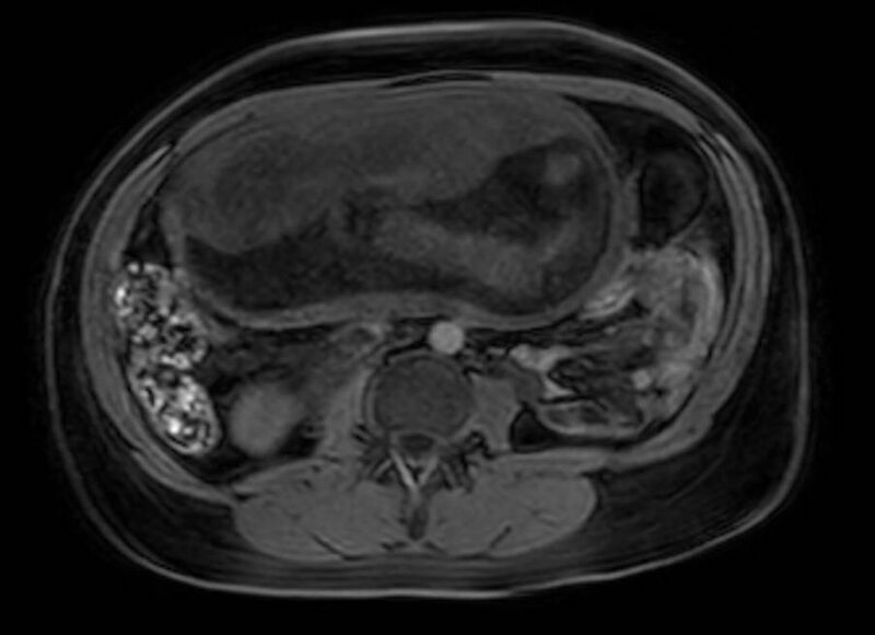 File:Appendicitis in gravida (MRI) (Radiopaedia 89433-106395 Axial DIXON 68).jpg
