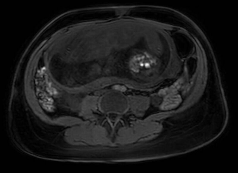 File:Appendicitis in gravida (MRI) (Radiopaedia 89433-106395 Axial DIXON 81).jpg