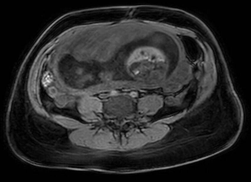 Appendicitis in gravida (MRI) (Radiopaedia 89433-106395 Axial DIXON 88).jpg