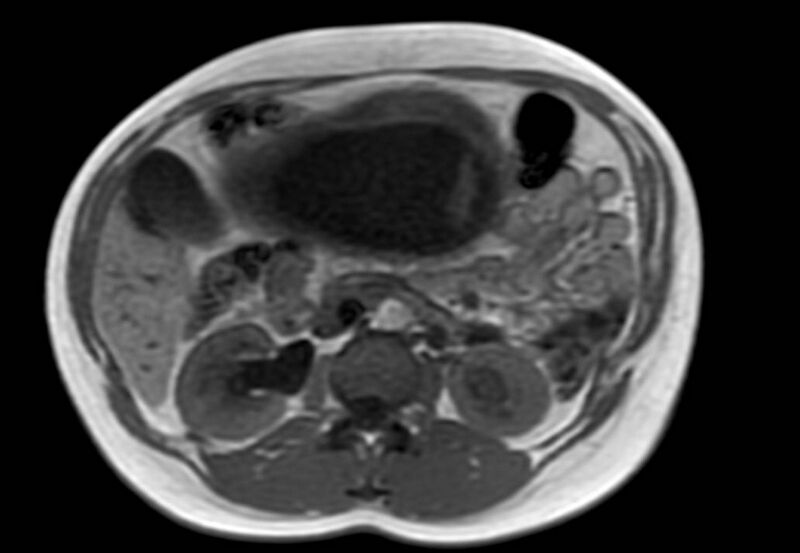 File:Appendicitis in gravida (MRI) (Radiopaedia 89433-106395 Axial T1 in-phase 26).jpg