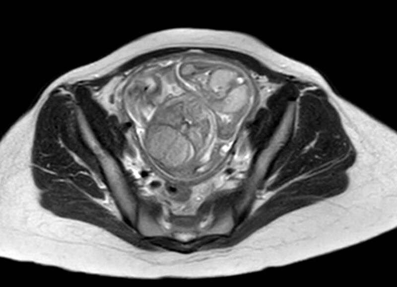 File:Appendicitis in gravida (MRI) (Radiopaedia 89433-106395 Axial T2 57).jpg