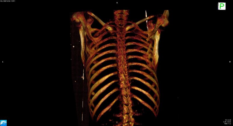 File:Arrow injury to the neck (Radiopaedia 75225-86323 3D bone 21).jpg