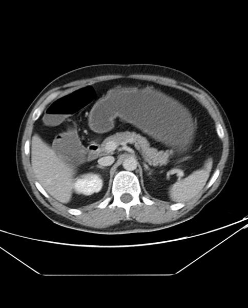 File:Arterial occlusive mesenteric ischemia (Radiopaedia 84641-100054 A 37).jpg