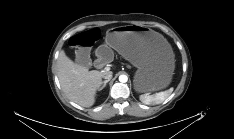 File:Arterial occlusive mesenteric ischemia (Radiopaedia 84641-100060 A 40).jpg