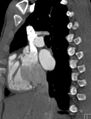 Arterial switch procedure (Radiopaedia 31607-32493 Sagittal 36).jpg