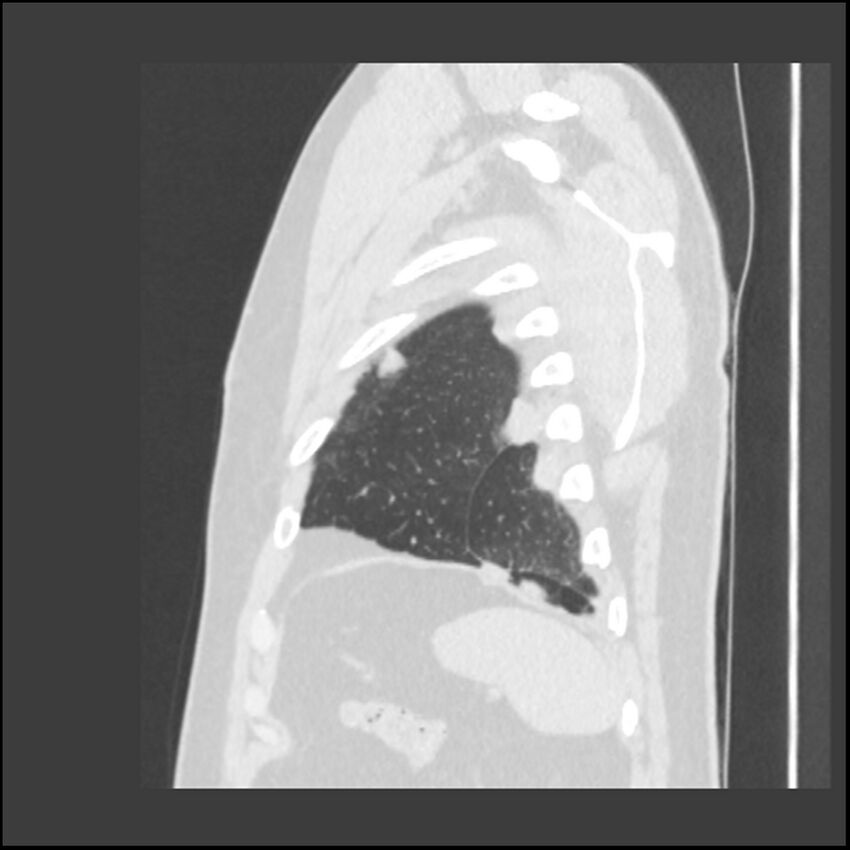 Asbestosis (Radiopaedia 45002-48961 Sagittal lung window 14).jpg
