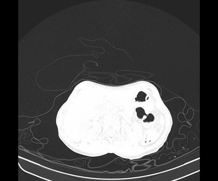 Aspergillomas (Radiopaedia 66779-76110 Axial lung window 52).jpg