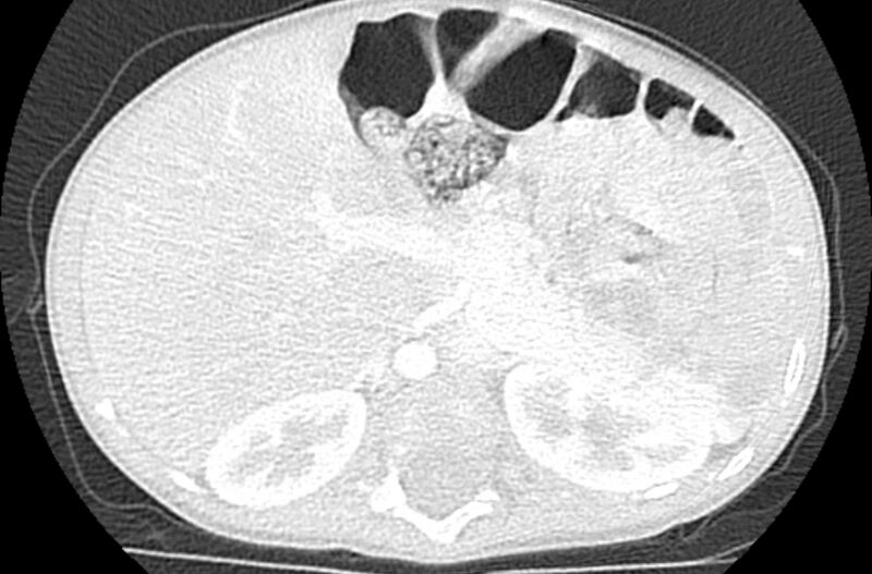 File:Asplenia syndrome (Radiopaedia 73083-83792 Axial lung window 83).jpg