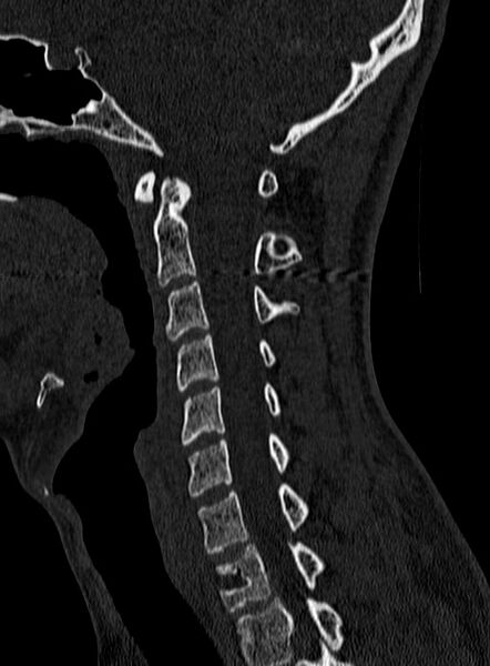 File:Atlantoaxial subluxation (Radiopaedia 44681-48450 Sagittal bone window 62).jpg