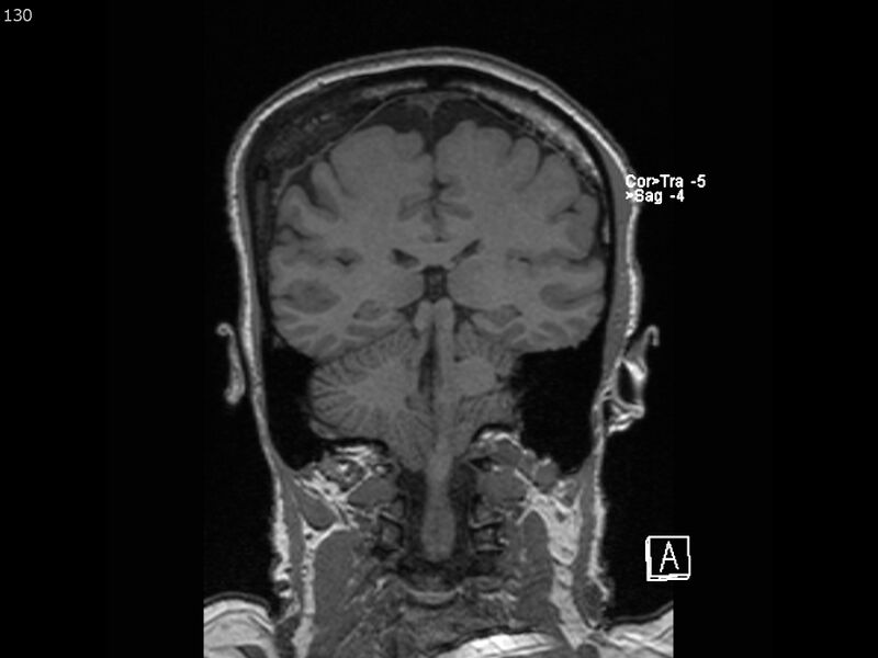 File:Atypical meningioma - intraosseous (Radiopaedia 64915-74572 Coronal T1 130).jpg