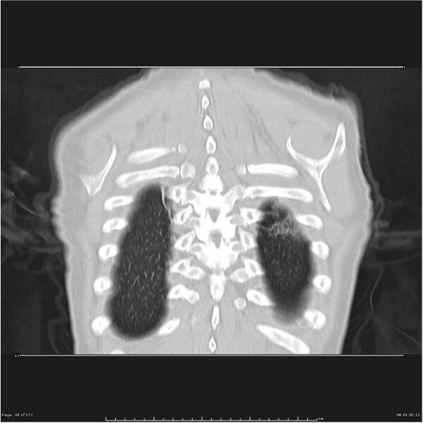File:Atypical pneumonia - Q fever (Radiopaedia 21993-21989 C 41).jpg