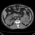 Autosomal dominant polycystic kidney disease (Radiopaedia 36539-38101 Axial non-contrast 36).jpg