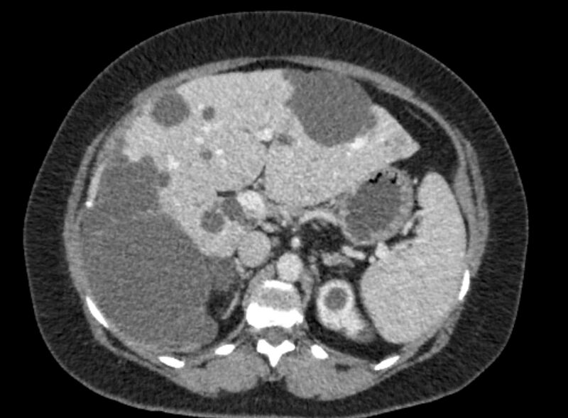 File:Autosomal dominant polycystic kidney disease (Radiopaedia 57124-64017 A 39).jpg