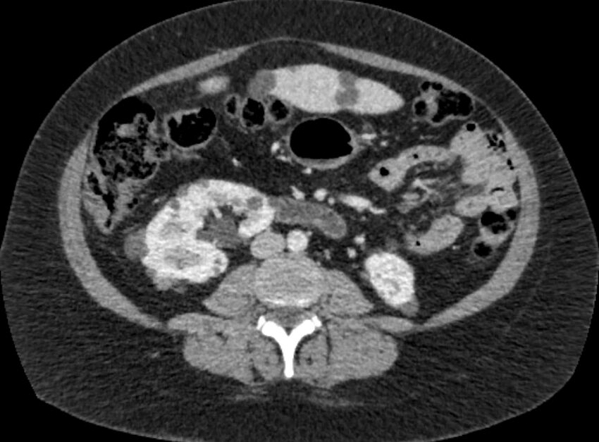 Autosomal dominant polycystic kidney disease (Radiopaedia 57124-64017 A 63).jpg