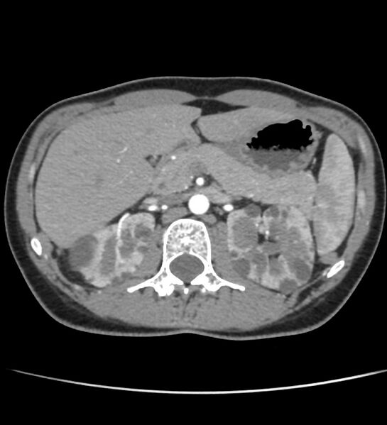 File:Autosomal dominant polycystic kidney disease - early onset (Radiopaedia 40734-43387 B 14).jpg