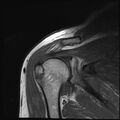 Avulsion fracture - greater tuberosity of humerus (Radiopaedia 71216-81515 Coronal T1 10).jpg