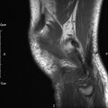 Avulsion fracture of the fibular head (Radiopaedia 74804-85808 D 29).jpg