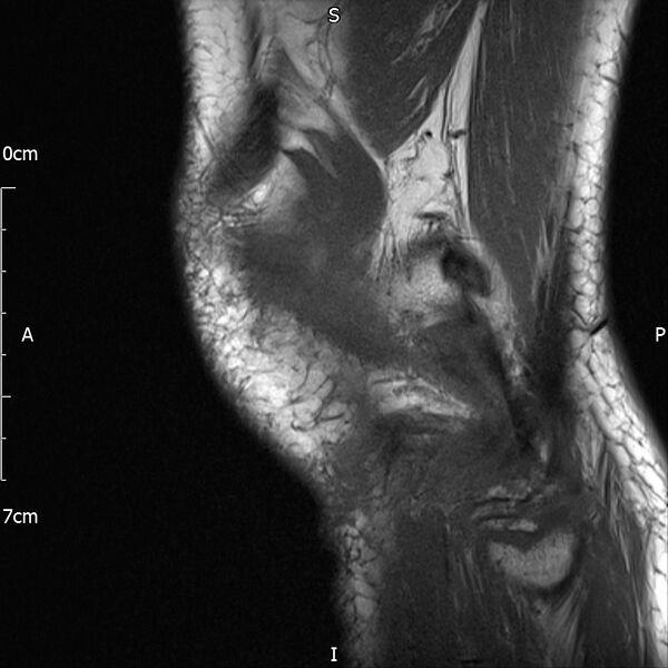 File:Avulsion fracture of the fibular head (Radiopaedia 74804-85808 D 29).jpg