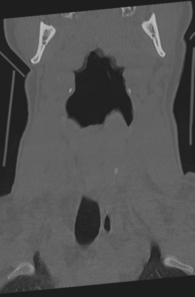 File:Axis peg fracture (type 3) and atlas lateral mass (type 4) fracture (Radiopaedia 37474-39324 Coronal bone window 4).png