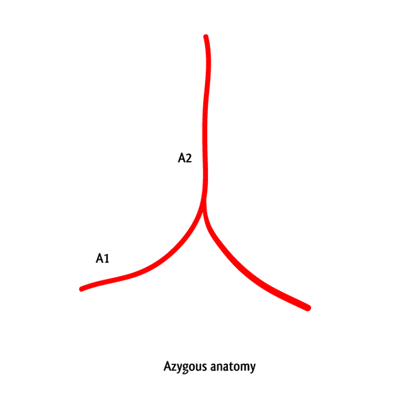 File:Azygos anterior cerebral artery (illustration) (Radiopaedia 10771-11230 Azygous anatomy 1).png