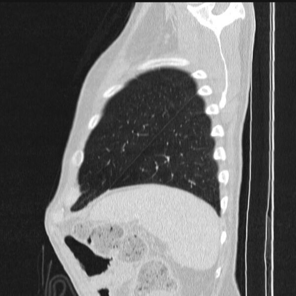 File:Azygos lobe (Radiopaedia 38259-40275 lung window 86).jpg