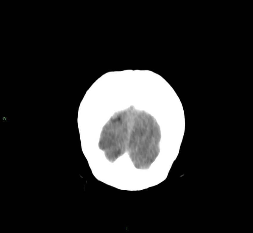 Basal ganglia hemorrhage (Radiopaedia 58759-65981 Coronal non-contrast 11).jpg