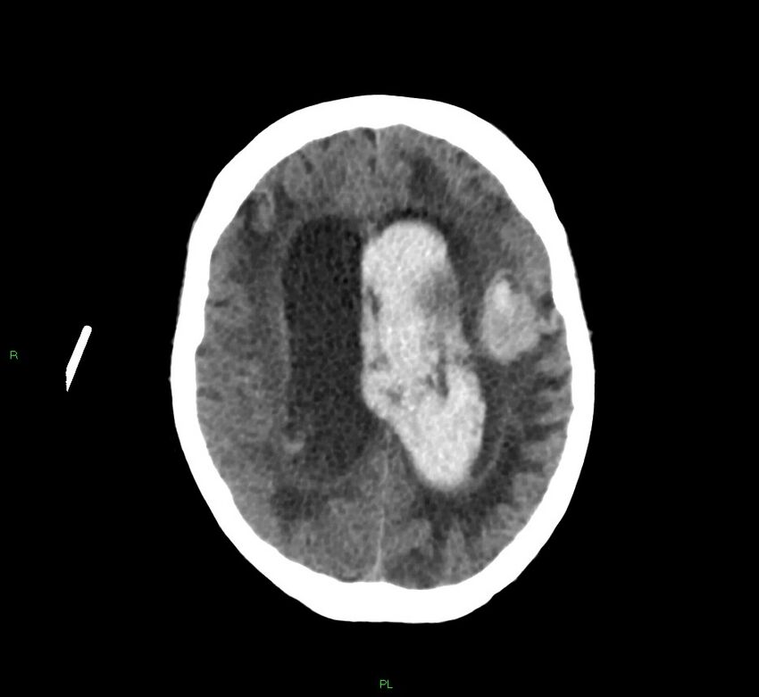 Basal ganglia hemorrhage (Radiopaedia 58766-65988 Axial non-contrast 25).jpg