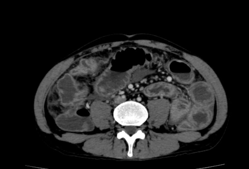 File:Behçet's disease- abdominal vasculitis (Radiopaedia 55955-62570 A 49).jpg