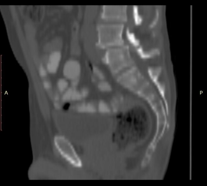 File:Bertolotti syndrome (Radiopaedia 58974-66235 Sagittal bone window 23).jpg