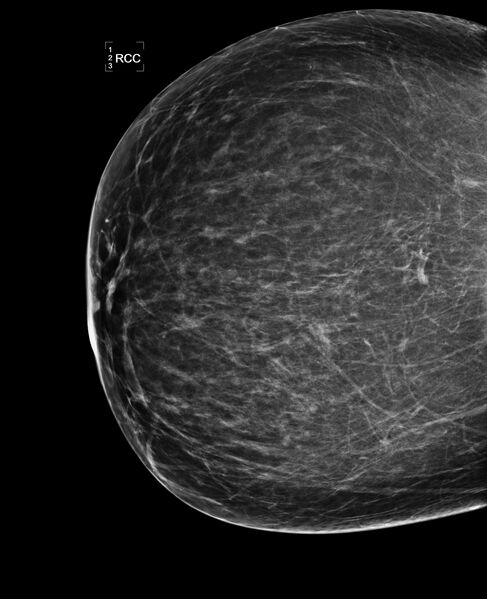 File:Bilateral accessory breast tissue (Radiopaedia 54239-60437 Right CC 1).jpg
