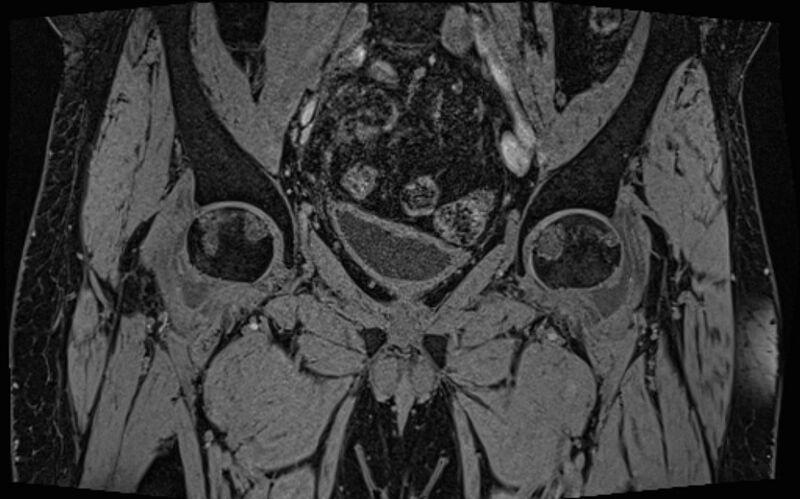 File:Bilateral avascular necrosis of femoral head (Radiopaedia 77116-89078 Coronal T2 we 56).jpg